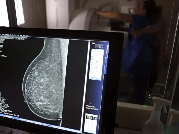 Periodicidade de mamografias divide médicos e autoridades de saúde
