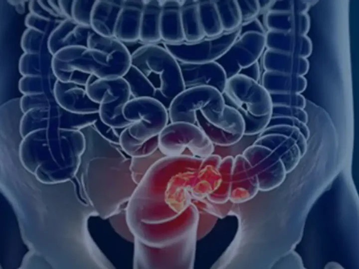 Rastreamento para câncer colorretal pode ser implementado no SUS